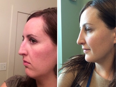 Rhinoplasty Denver