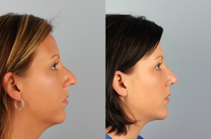 What You Need To Know Before Rhinoplasty